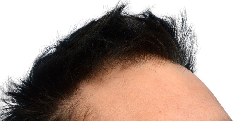 Fue Before and After | Dr. Jeffrey Wise