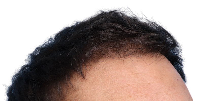 Fue Before and After | Dr. Jeffrey Wise