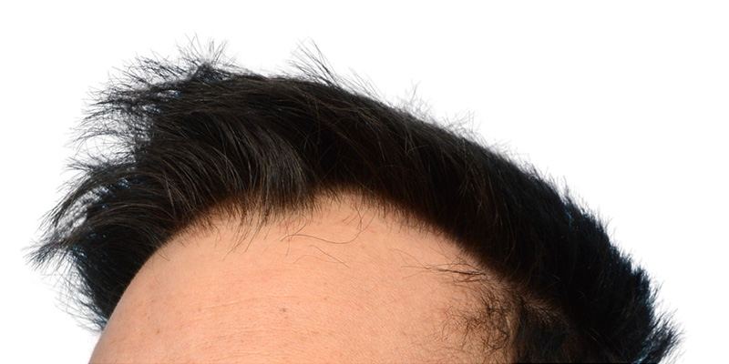 Fue Before and After | Dr. Jeffrey Wise