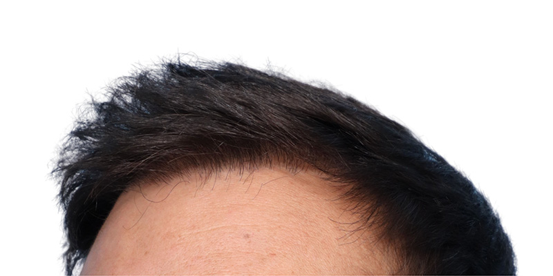 Fue Before and After | Dr. Jeffrey Wise