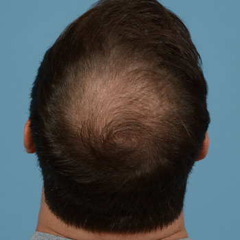 Fue Before and After | Dr. Jeffrey Wise