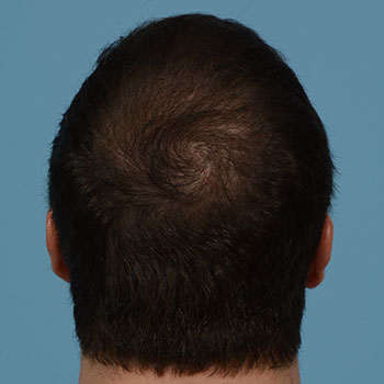 Fue Before and After | Dr. Jeffrey Wise