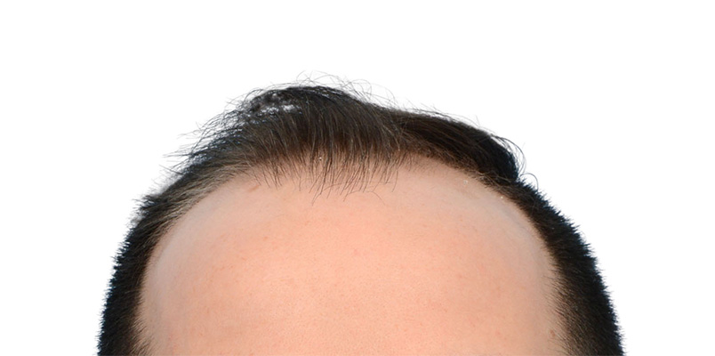 Fue Before and After | Dr. Jeffrey Wise