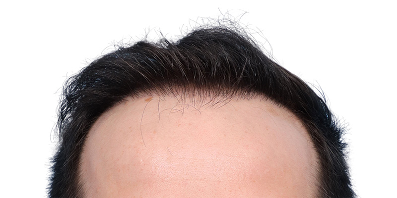 Fue Before and After | Dr. Jeffrey Wise