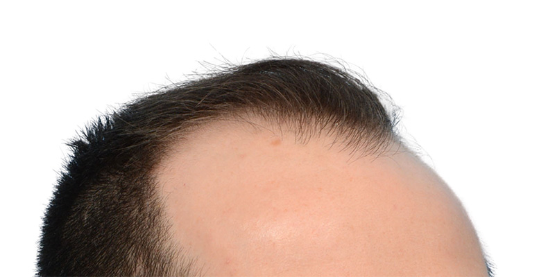 Fue Before and After | Dr. Jeffrey Wise