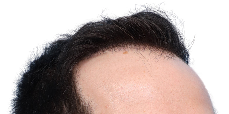 Fue Before and After | Dr. Jeffrey Wise