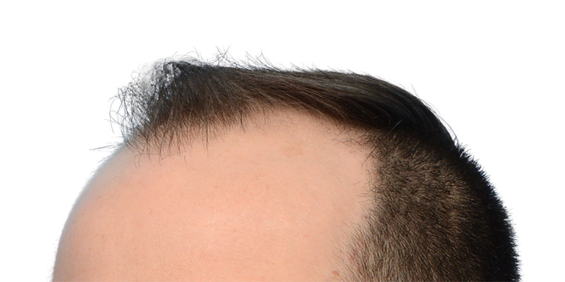 Fue Before and After | Dr. Jeffrey Wise