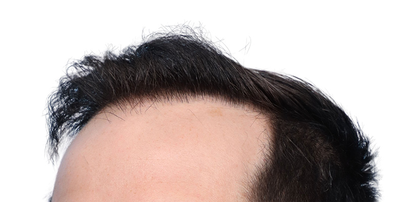 Fue Before and After | Dr. Jeffrey Wise