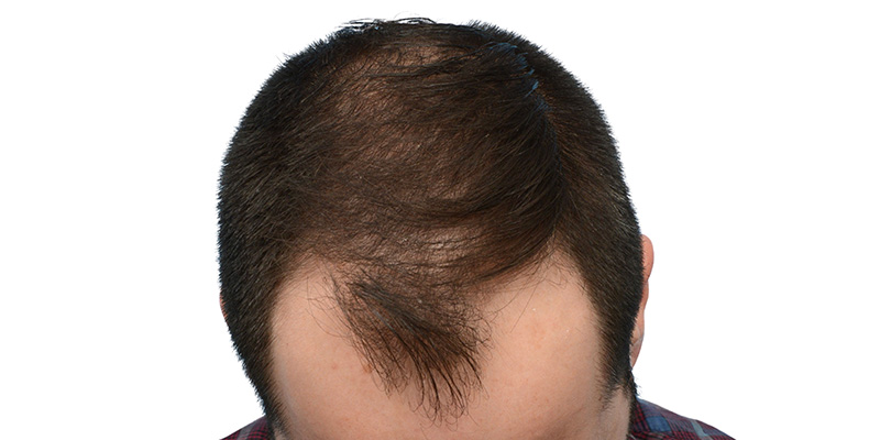 Fue Before and After | Dr. Jeffrey Wise