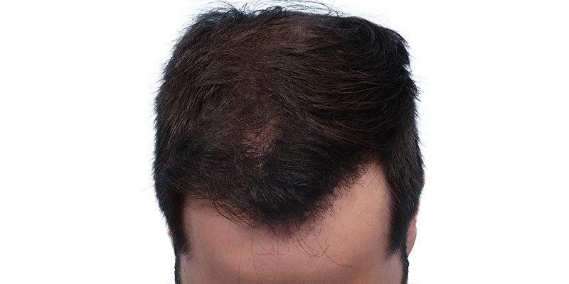 Fue Before and After | Dr. Jeffrey Wise