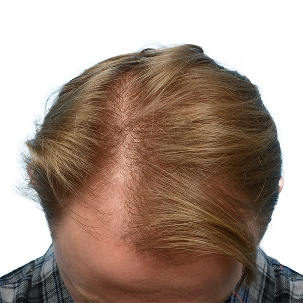 Fue Before and After | Dr. Jeffrey Wise