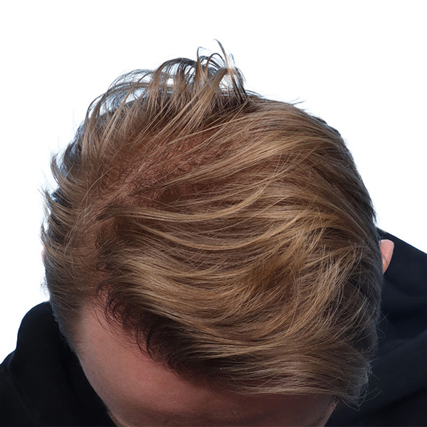 Fue Before and After | Dr. Jeffrey Wise