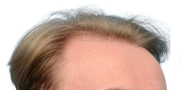 Fue Before and After | Dr. Jeffrey Wise