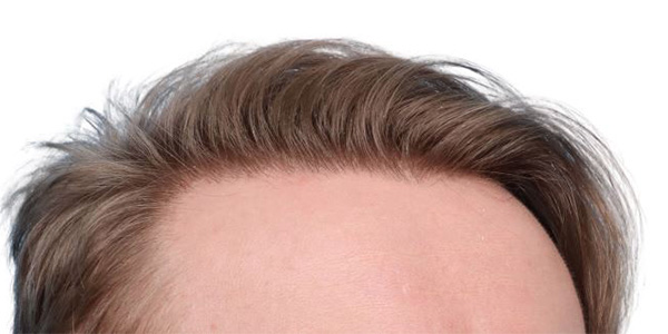 Fue Before and After | Dr. Jeffrey Wise