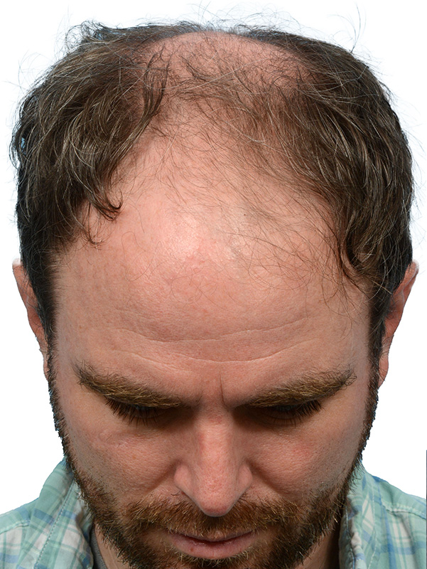 Fue Before and After | Dr. Jeffrey Wise