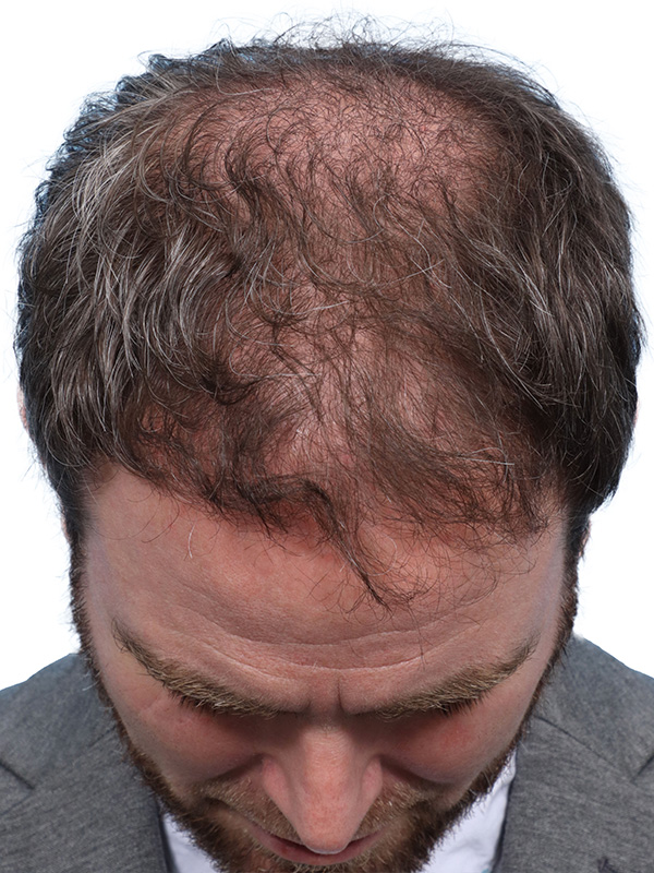 Fue Before and After | Dr. Jeffrey Wise