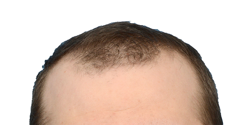 Fue Before and After | Dr. Jeffrey Wise