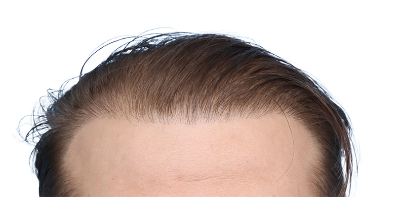 Fue Before and After | Dr. Jeffrey Wise