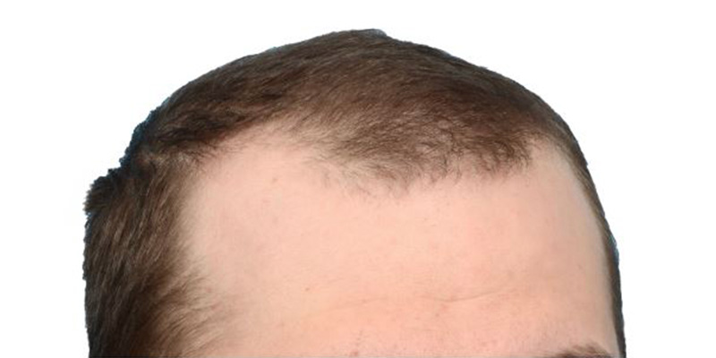 Fue Before and After | Dr. Jeffrey Wise