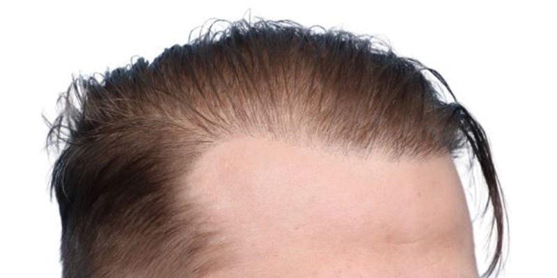 Fue Before and After | Dr. Jeffrey Wise