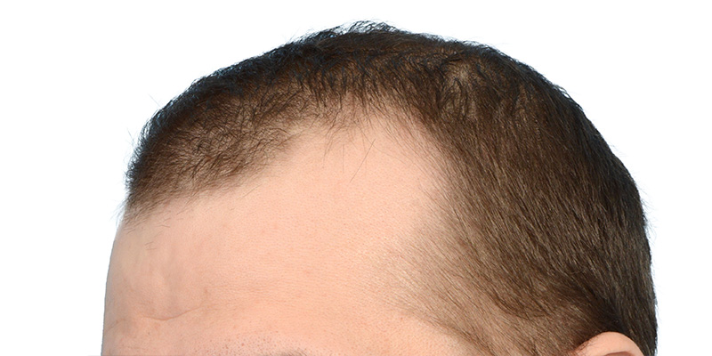 Fue Before and After | Dr. Jeffrey Wise