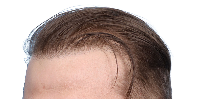 Fue Before and After | Dr. Jeffrey Wise