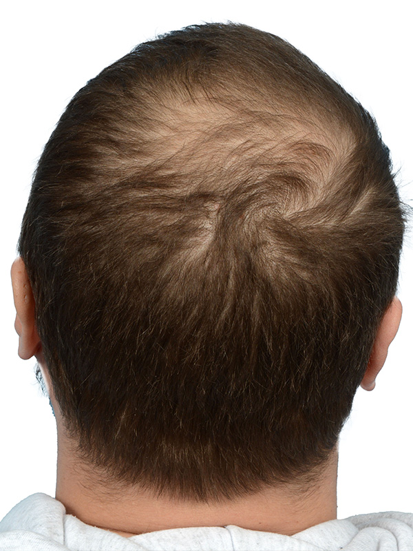 Fue Before and After | Dr. Jeffrey Wise