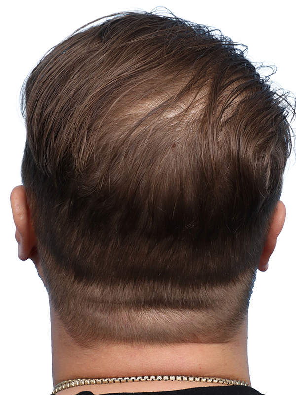 Fue Before and After | Dr. Jeffrey Wise