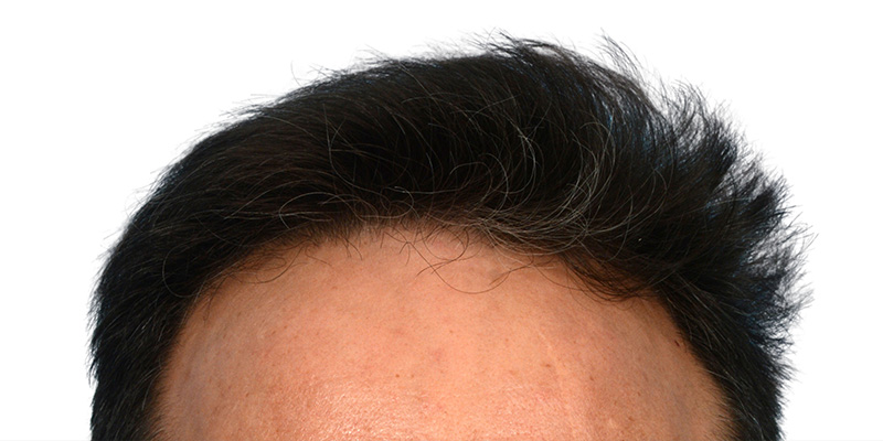 Fue Before and After | Dr. Jeffrey Wise