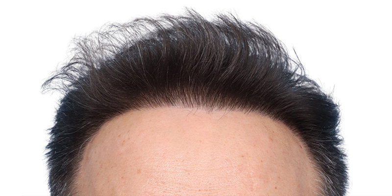 Fue Before and After | Dr. Jeffrey Wise