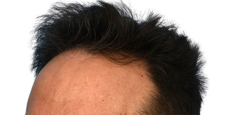 Fue Before and After | Dr. Jeffrey Wise