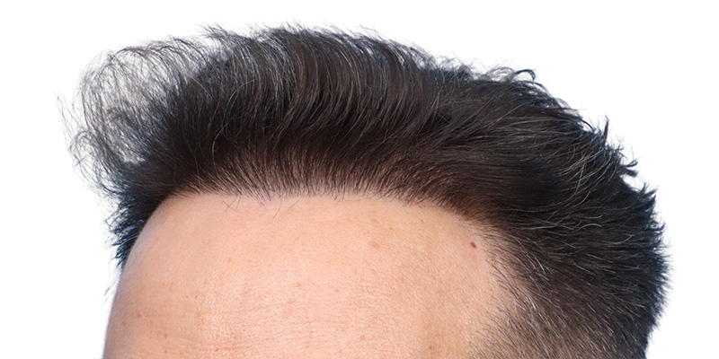 Fue Before and After | Dr. Jeffrey Wise