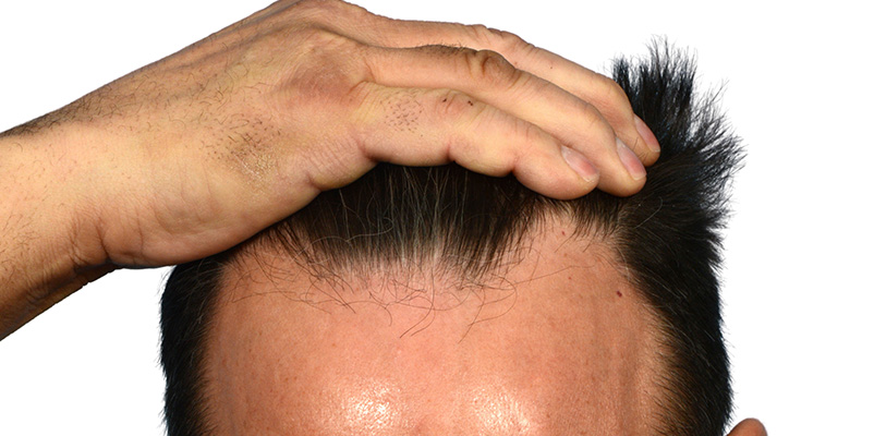 Fue Before and After | Dr. Jeffrey Wise