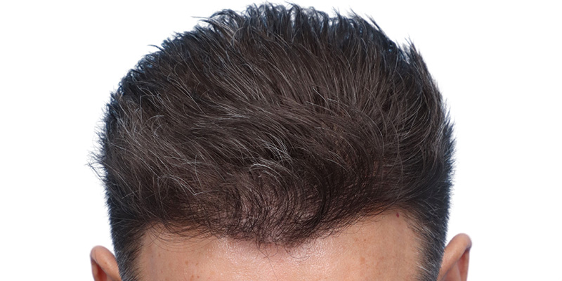 Fue Before and After | Dr. Jeffrey Wise