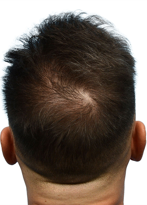 Fue Before and After | Dr. Jeffrey Wise