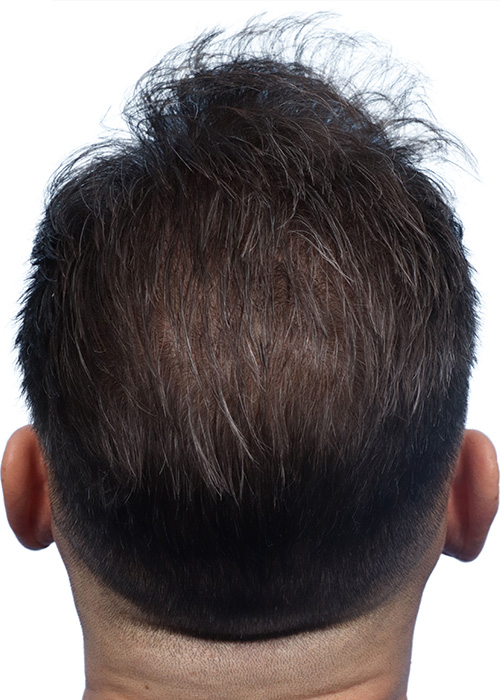 Fue Before and After | Dr. Jeffrey Wise