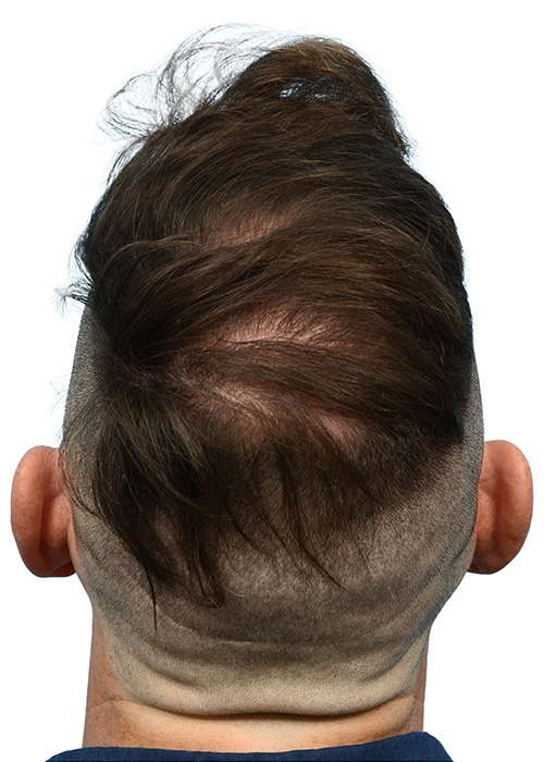 Fue Before and After | Dr. Jeffrey Wise