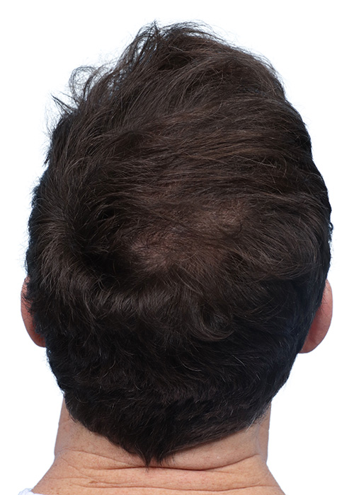 Fue Before and After | Dr. Jeffrey Wise