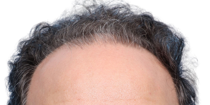 Fue Before and After | Dr. Jeffrey Wise