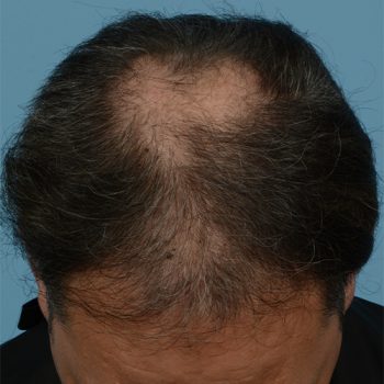 Fue Before and After | Dr. Jeffrey Wise