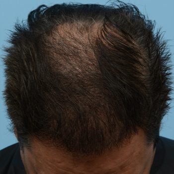 Fue Before and After | Dr. Jeffrey Wise