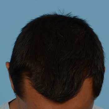 Fue Before and After | Dr. Jeffrey Wise