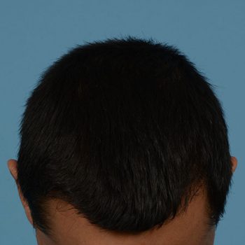 Fue Before and After | Dr. Jeffrey Wise