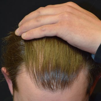 Fue Before and After | Dr. Jeffrey Wise