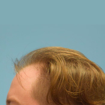 Fue Before and After | Dr. Jeffrey Wise