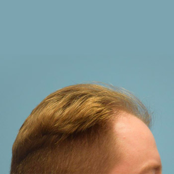 Fue Before and After | Dr. Jeffrey Wise