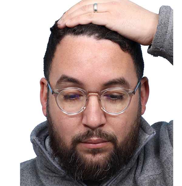 Fue Before and After | Dr. Jeffrey Wise