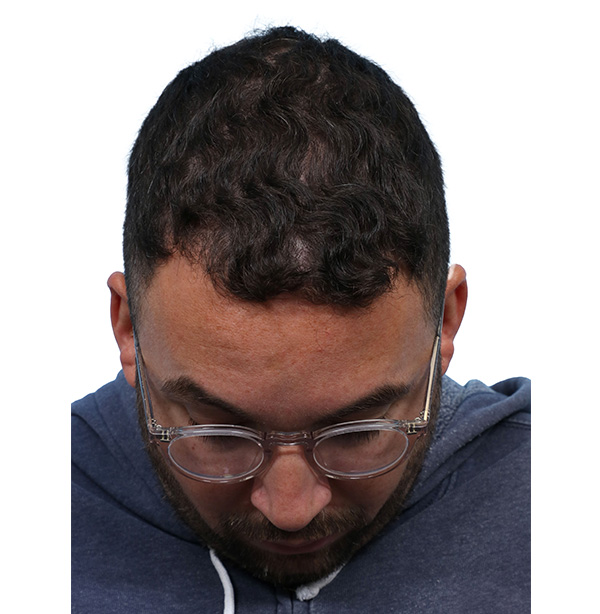 Fue Before and After | Dr. Jeffrey Wise