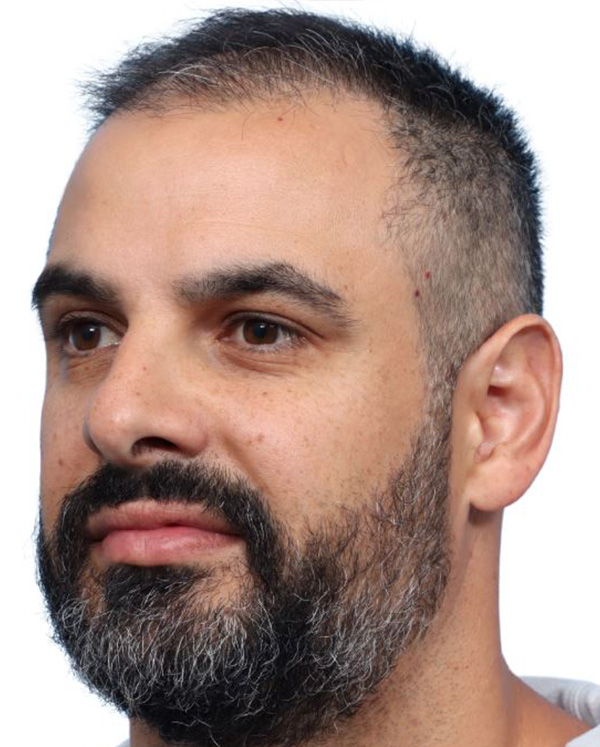 Fue Before and After | Dr. Jeffrey Wise