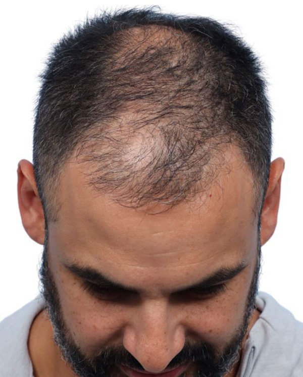 Fue Before and After | Dr. Jeffrey Wise